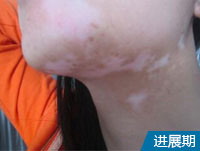 阜阳治疗白斑的医院