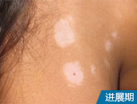 阜阳白斑哪家医院好