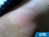 阜阳儿童白斑医院