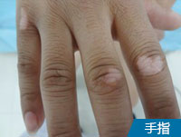 阜阳专治白斑的医院