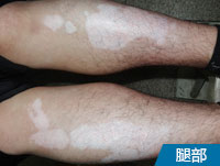 阜阳正规白斑医院哪家好