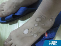 阜阳白斑专业医院