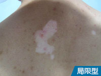 阜阳市白斑医院哪家好