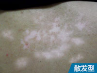 阜阳白斑医院客服号码